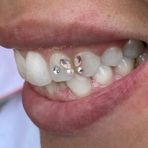 Tooth Gems